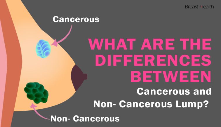 What are the differences between Cancerous and Non- Cancerous Lump?