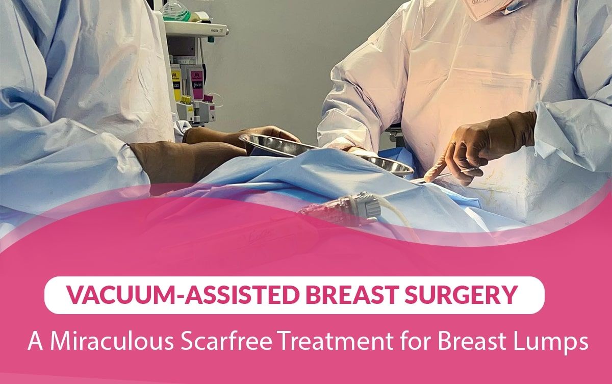 Vacuum-Assisted Breast Surgery- A Miraculous Scar-Free Treatment for Breast Lumps