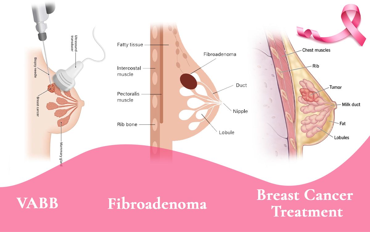 Get the Best Treatment for Breast Diseases from the Top Breast Surgeon in Delhi NCR